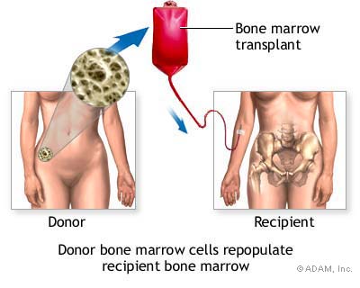bone marrow transplant